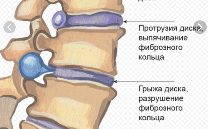 Грыжа позвоночника дают группу инвалидности. Нуклеопластика межпозвонкового. Дискоз позвоночника. Нуклеопластика грыжи позвоночника. Дискоз шейного отдела позвоночника.